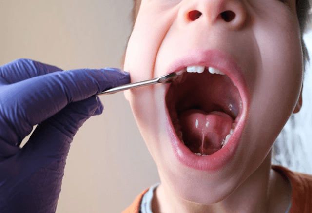 a child patient opening mouth before undergoing lip/tongue-tie treatment