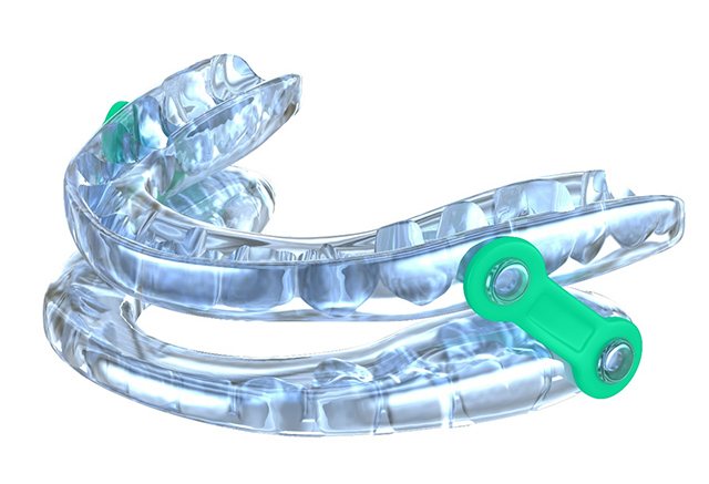 An oral appliance in Tulsa