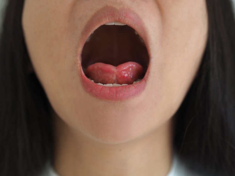A child opening their mouth to reveal their tongue-tie